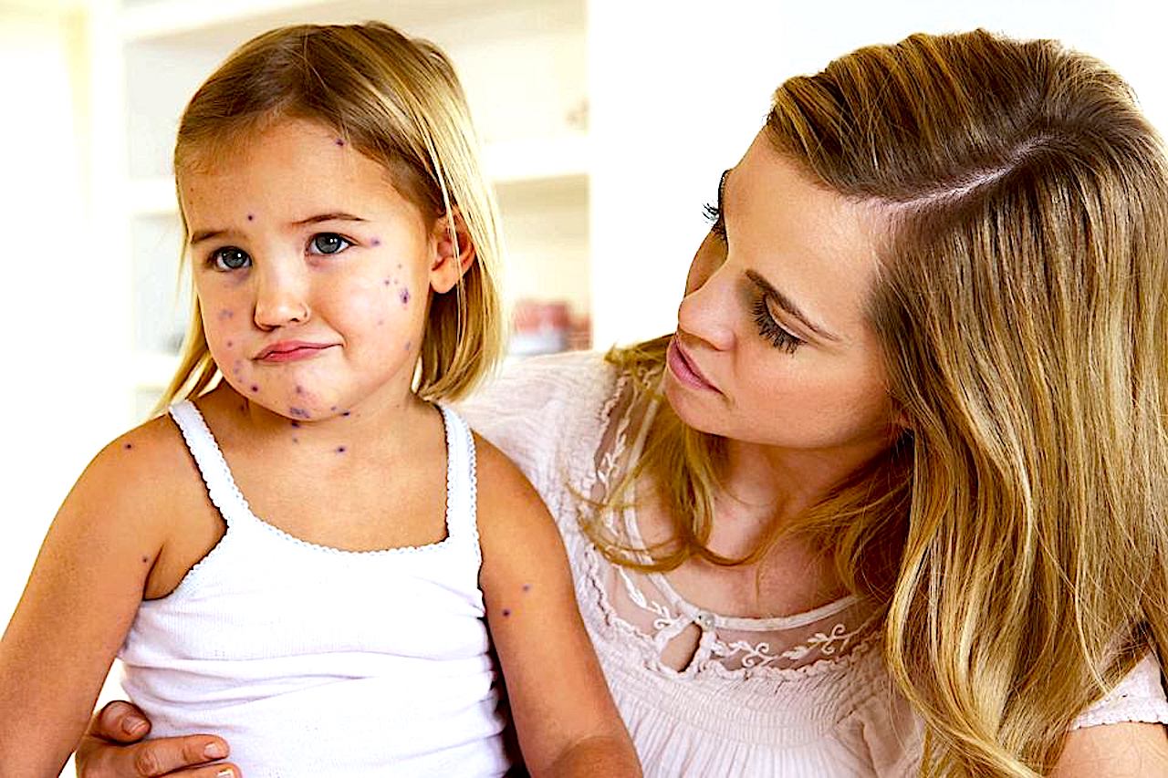 To choroba, której można uniknąć – oszczędź dziecku ospy